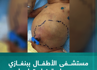 مستشفى الأطفال ببنغازي يجري عملية نادرة لمولود بداخله جنين